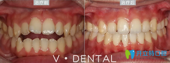 維恩口腔前牙開合矯正案例