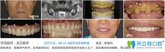 南京博韻口腔種植牙真人案例