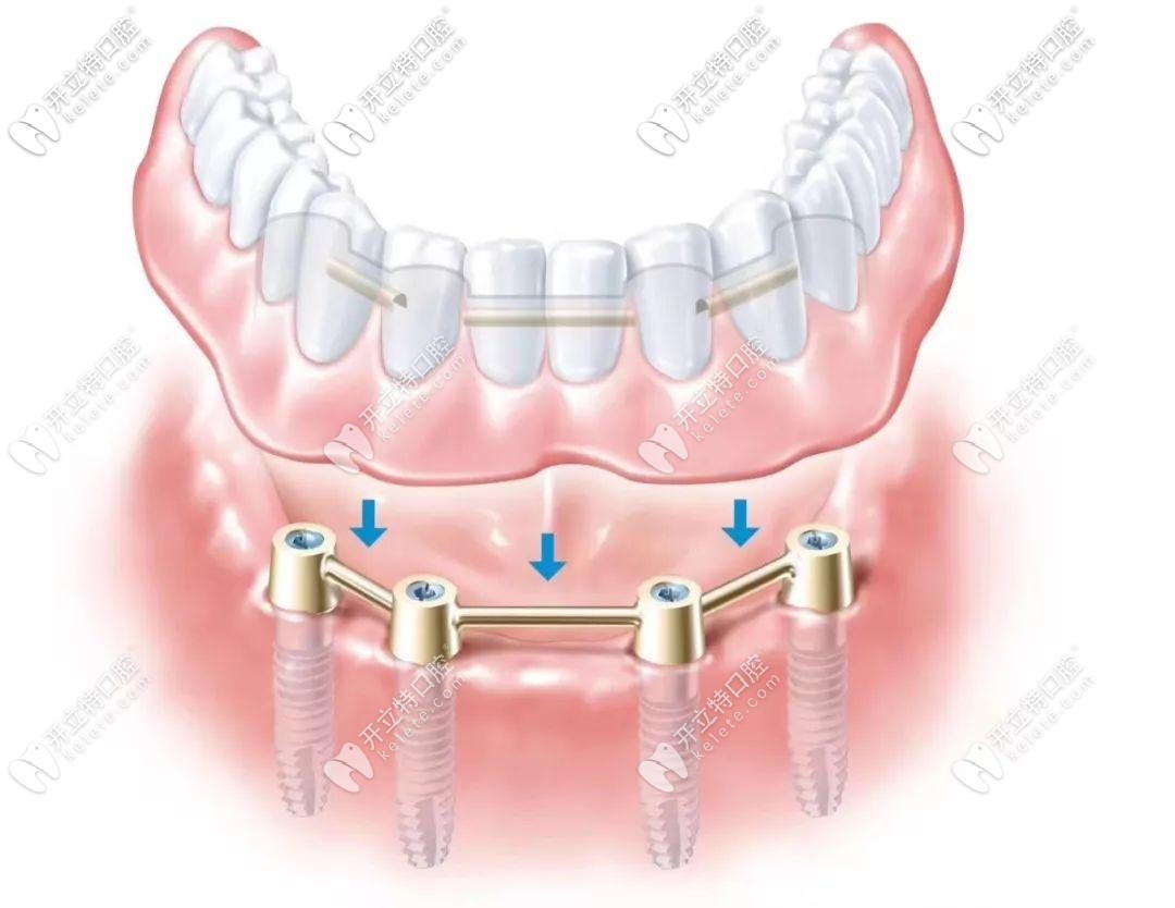 all-on-4種植牙技術(shù)