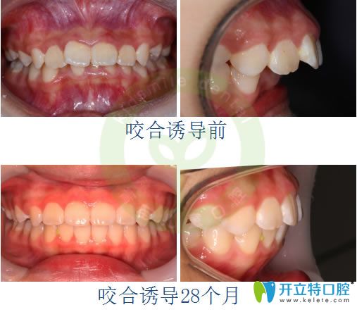 成都青苗口腔深覆蓋矯正后臉型變化圖