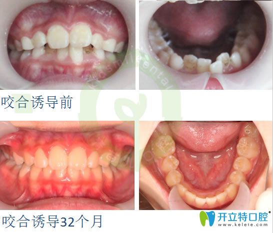 兒童牙齒擁擠矯正前后對比照