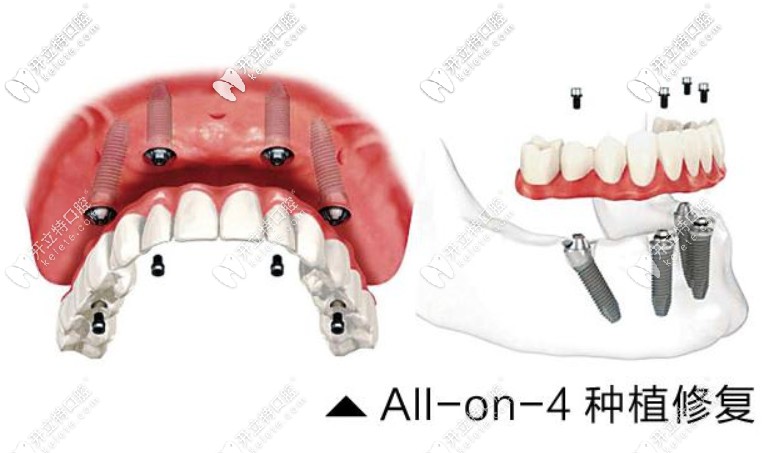 Allon4即刻種植牙