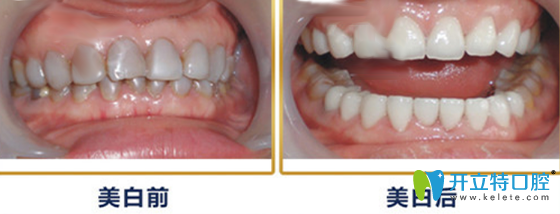 牙衛(wèi)士口腔班氟斑牙治療案例前后效果對(duì)比