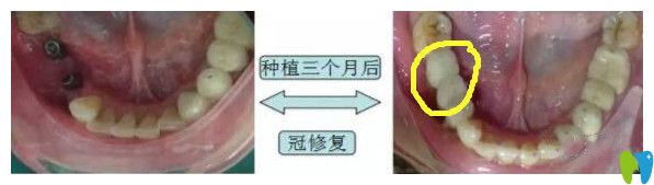 鵬博口腔種植牙案例