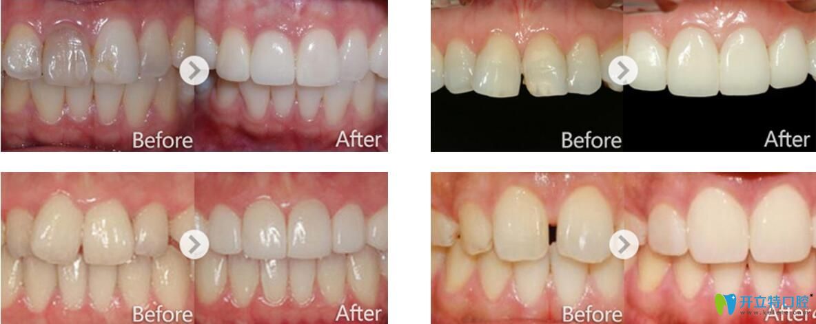 武漢愛思特口腔怎么樣，好不好？牙貼面修復案例效果來證明