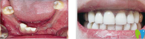 長沙雅美口腔種植牙前后效果對比圖