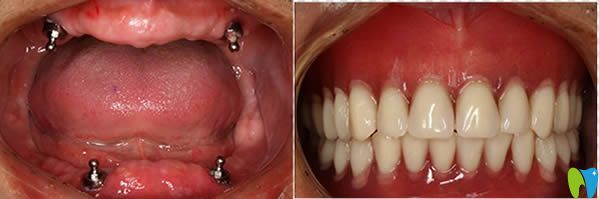 長沙齒邦口腔高難度全口種植牙案例