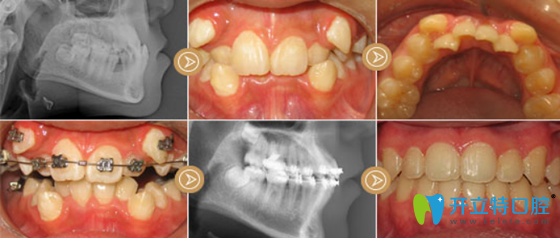 好佰年口腔虎牙矯正案例