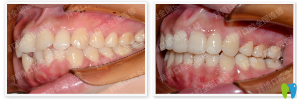 佛山拜博口腔牙齒矯正案例對比圖