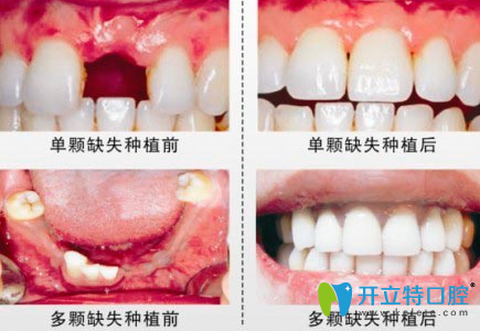 寧波恒美口腔種植牙案例效果圖