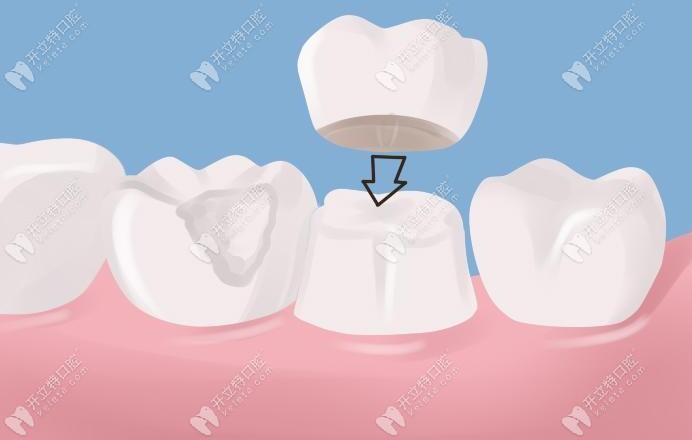 樂(lè)道口腔牙冠修復(fù)