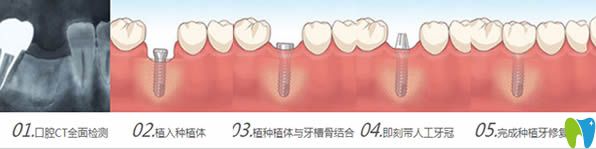 種植牙手術(shù)流程