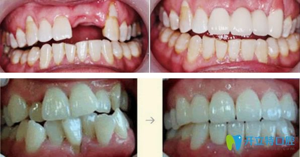 門牙缺失種植+牙齒擁擠錯位矯正后效果