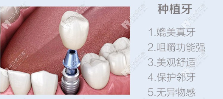 種植牙的優(yōu)勢