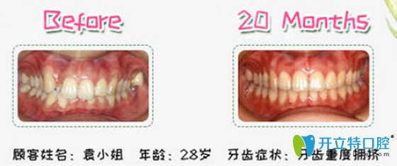 沈陽歡樂口腔隱適美矯正案例