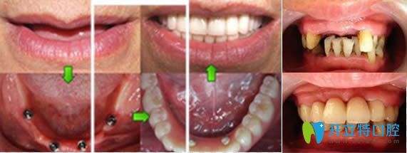 合肥美奧微創(chuàng)即刻種牙和ALL-ON-4種牙案例圖