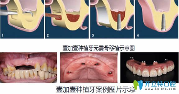 合肥壹加壹無需骨移植圖示及種植牙案例圖