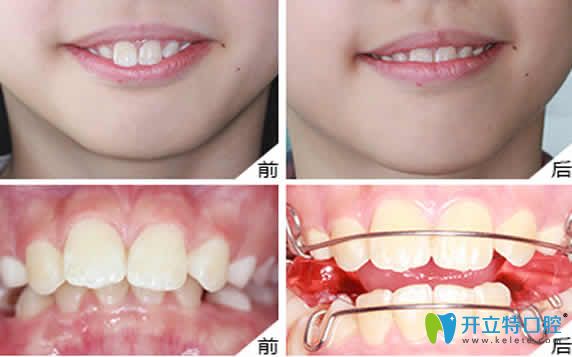 無錫金貝齊齒科牙齒矯正效果圖
