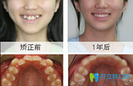 廈門登特口腔牙齒矯正前后效果對(duì)比圖