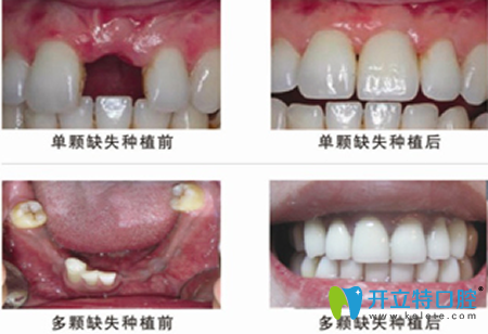 廈門登特口腔牙齒種植前后效果對(duì)比圖