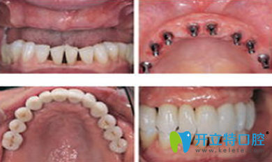 廈門天使口腔種植牙前后效果對比圖
