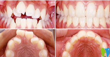 廈門天使口腔牙齒矯正效果對比圖