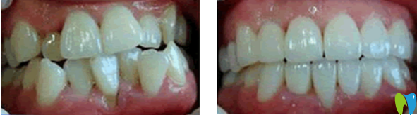 東南口腔矯正牙齒效果怎么樣