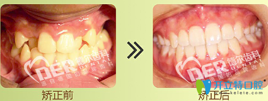 福州德爾齒科美學正畸效果圖