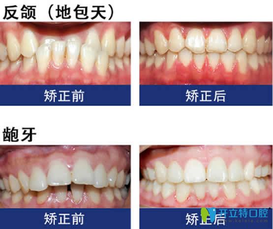 福州晶美口腔牙齒矯正案例效果