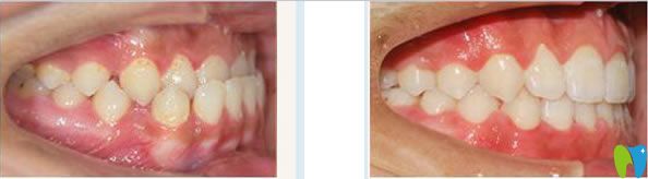 南寧柏樂(lè)口腔門(mén)牙反頜矯正前后對(duì)比案例