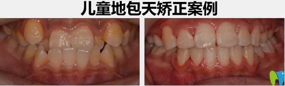 兒童地包天牙齒矯正前后以比效果