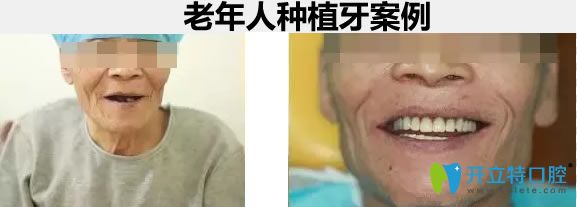 南昌維樂60歲老年人全口種植牙真實案例