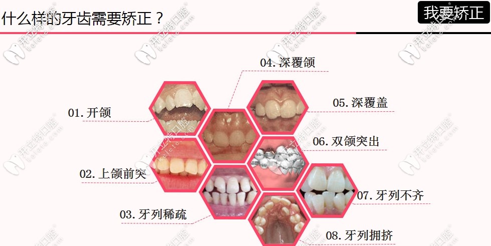 牙齒矯正適應(yīng)癥