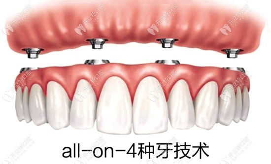 all-on-4種植牙技術(shù)