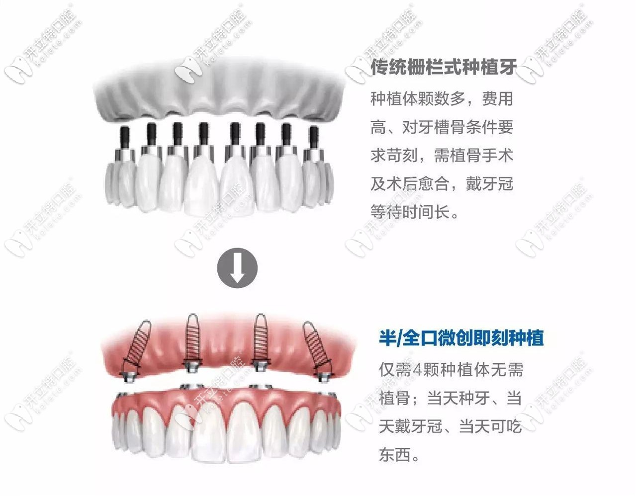 傳統(tǒng)種植牙和即刻種植牙區(qū)別