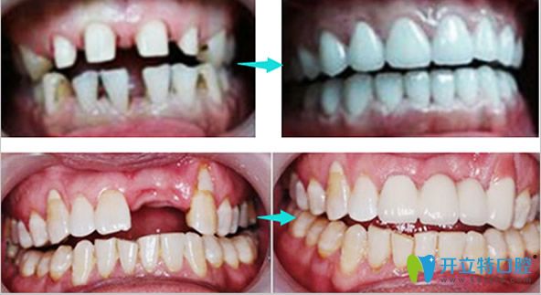 愛(ài)國(guó)口腔牙列稀疏美學(xué)修復(fù)+多顆牙缺失種植效果案例
