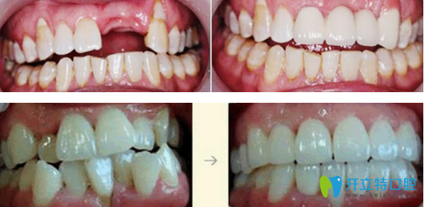 佳美口腔種植牙和牙齒矯正效果案例