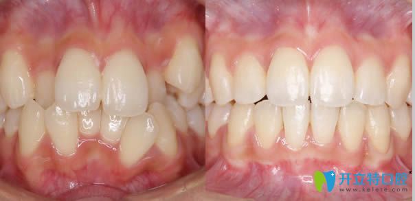 大連博大口腔牙齒矯正案例效果對比圖