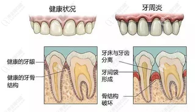 長春傳陽牙周疾病、根管治療