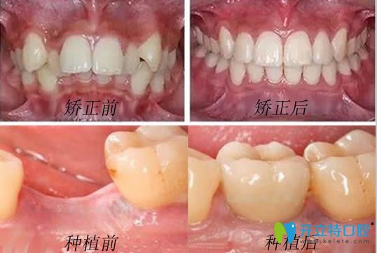 哈爾濱瑞益口腔牙齒正畸和種植牙案例效果對(duì)比圖