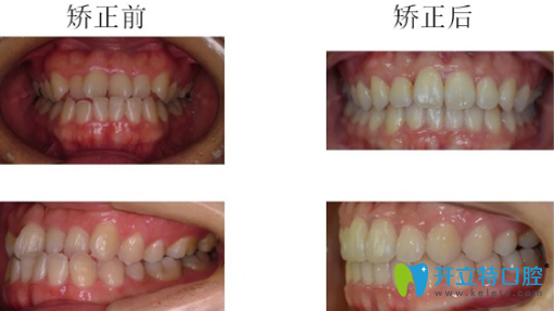 哈爾濱大象牙科牙齒隱形矯正前后正側(cè)面對(duì)比圖