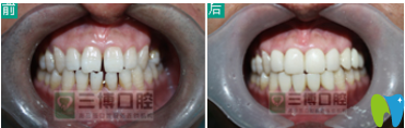 石家莊三博口腔牙齒矯正案例