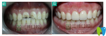 石家莊三博口腔烤瓷牙案例效果