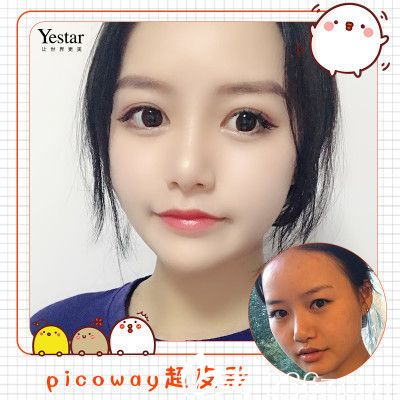 深圳yestar整形醫(yī)院莎綜合美眼雙眼皮案例