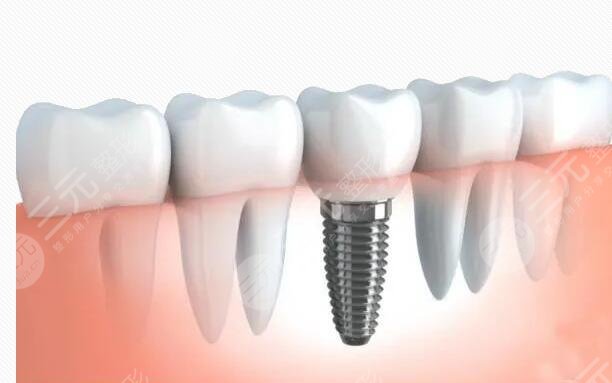 牙齒種植前要注意什么